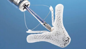 Abbott MitraClip REPAIR MR Válvula Mitral FDA Cardiología